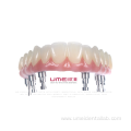 Full Arch Zirconia Malo Bridge